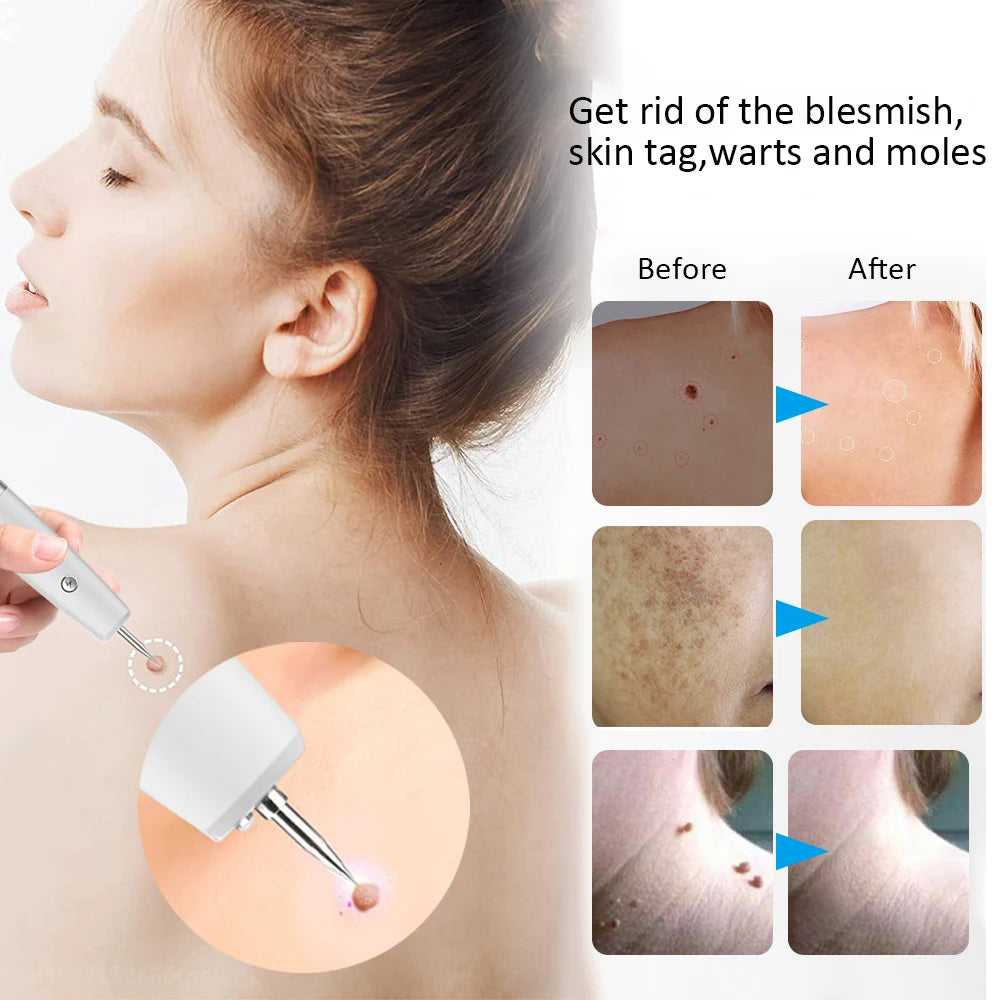 Skin Tag Mole Remover for Dark Spots Laser Plasma Pen Electric Blemish Wart Remover lcd Freckle Eliminator Black Dots Removal