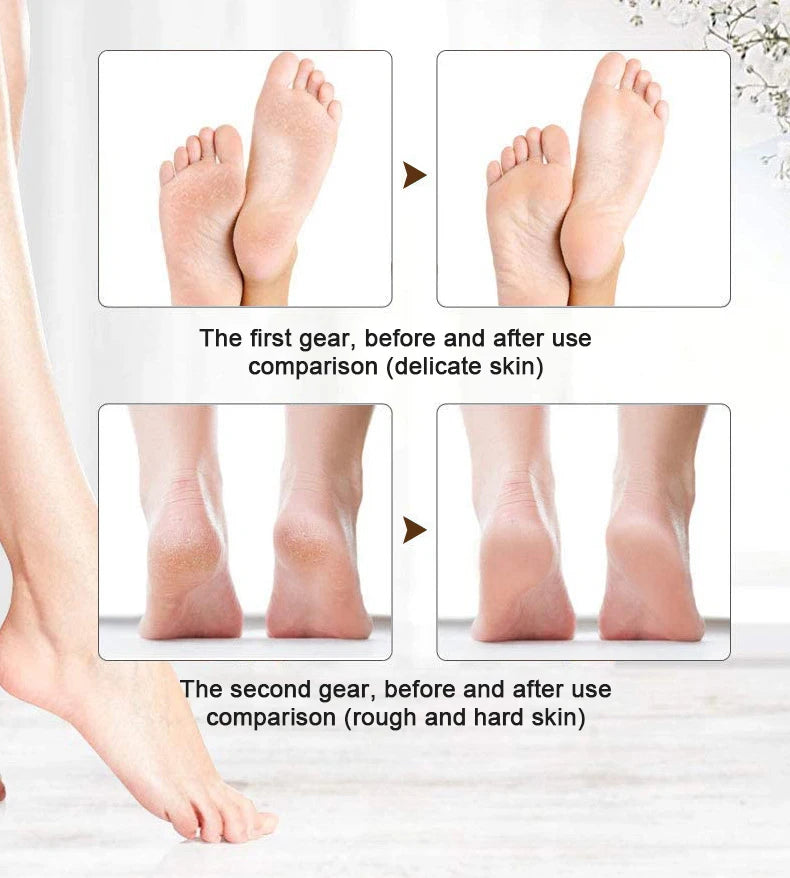 Electric Callus Remover for Feet,