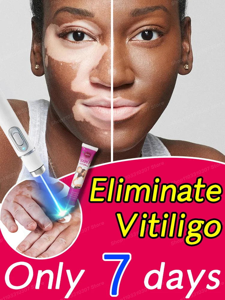 Vitiligo Laser