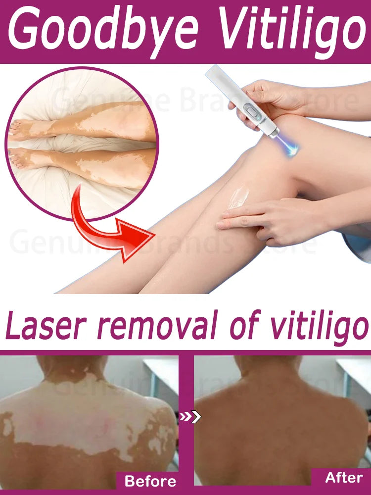 Vitiligo Laser