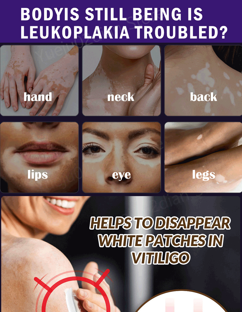 Vitiligo Laser