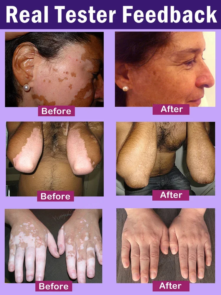 Vitiligo Laser