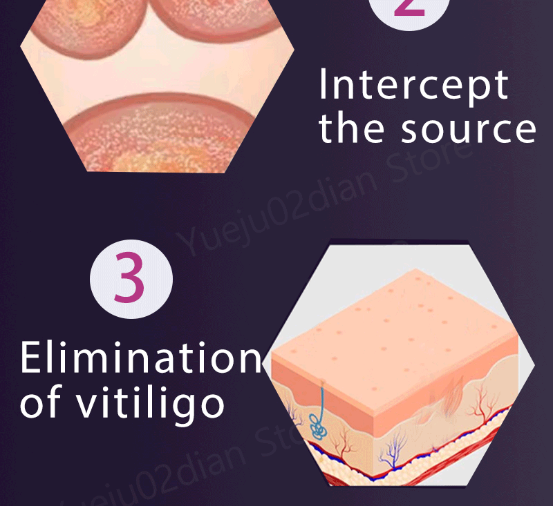 Vitiligo Laser